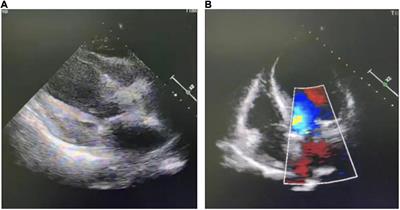 PCSK9 inhibitors in a renal transplant patient complicated with hepatitis B: A case report and literature review